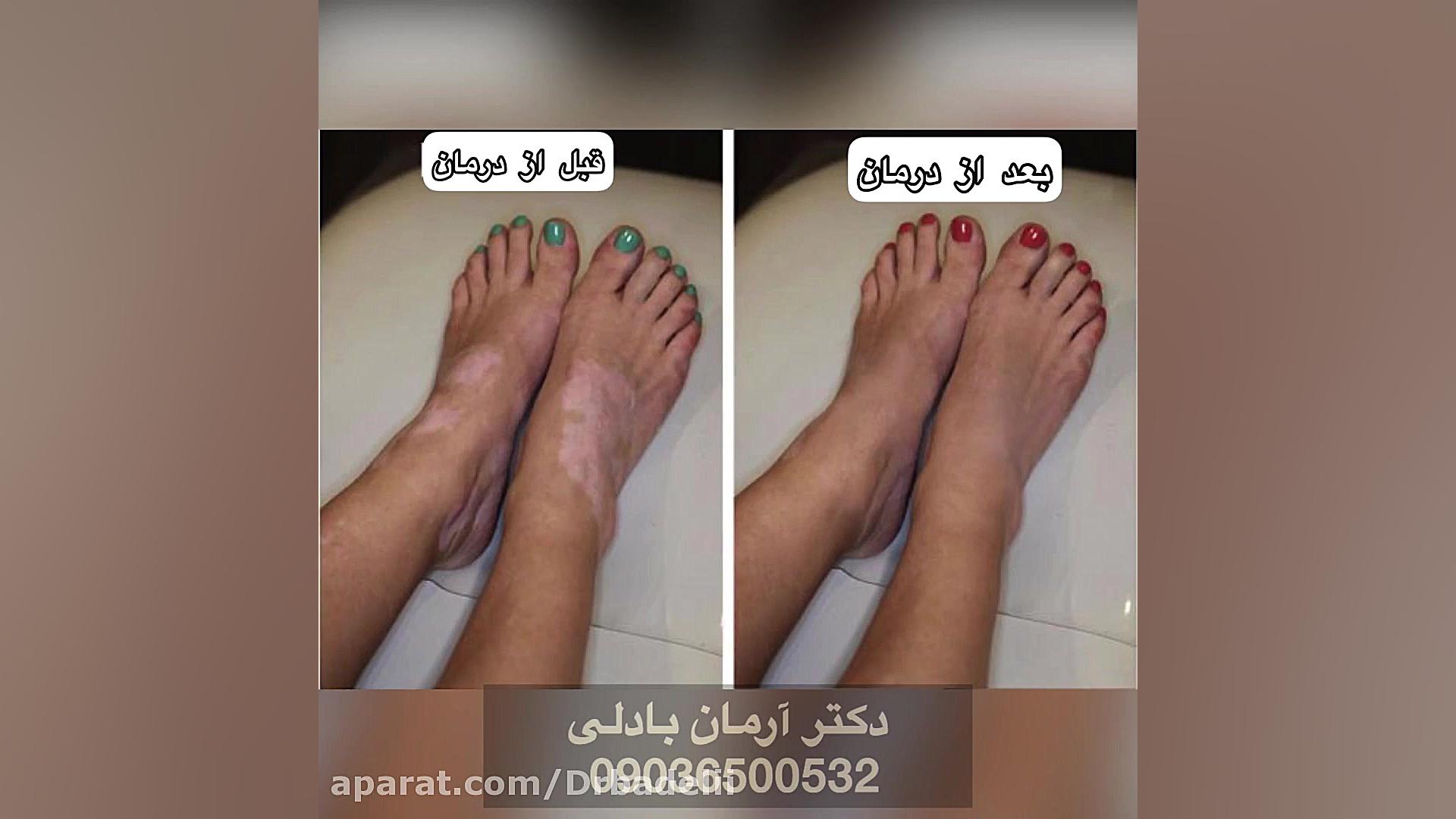 درمان قطعی بیماری پیسی کشف شد! مزوتراپی