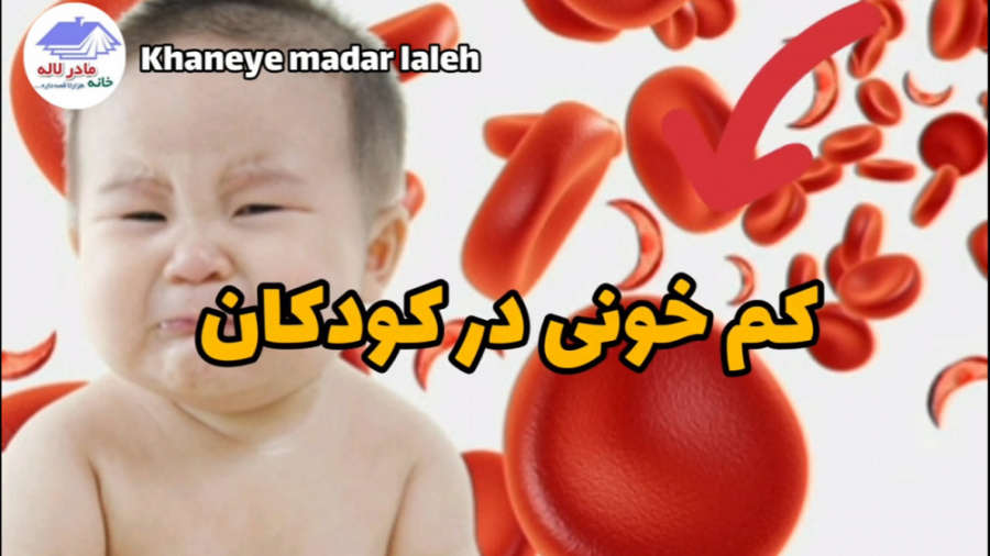 کم خونی در کودکان کاشت مو