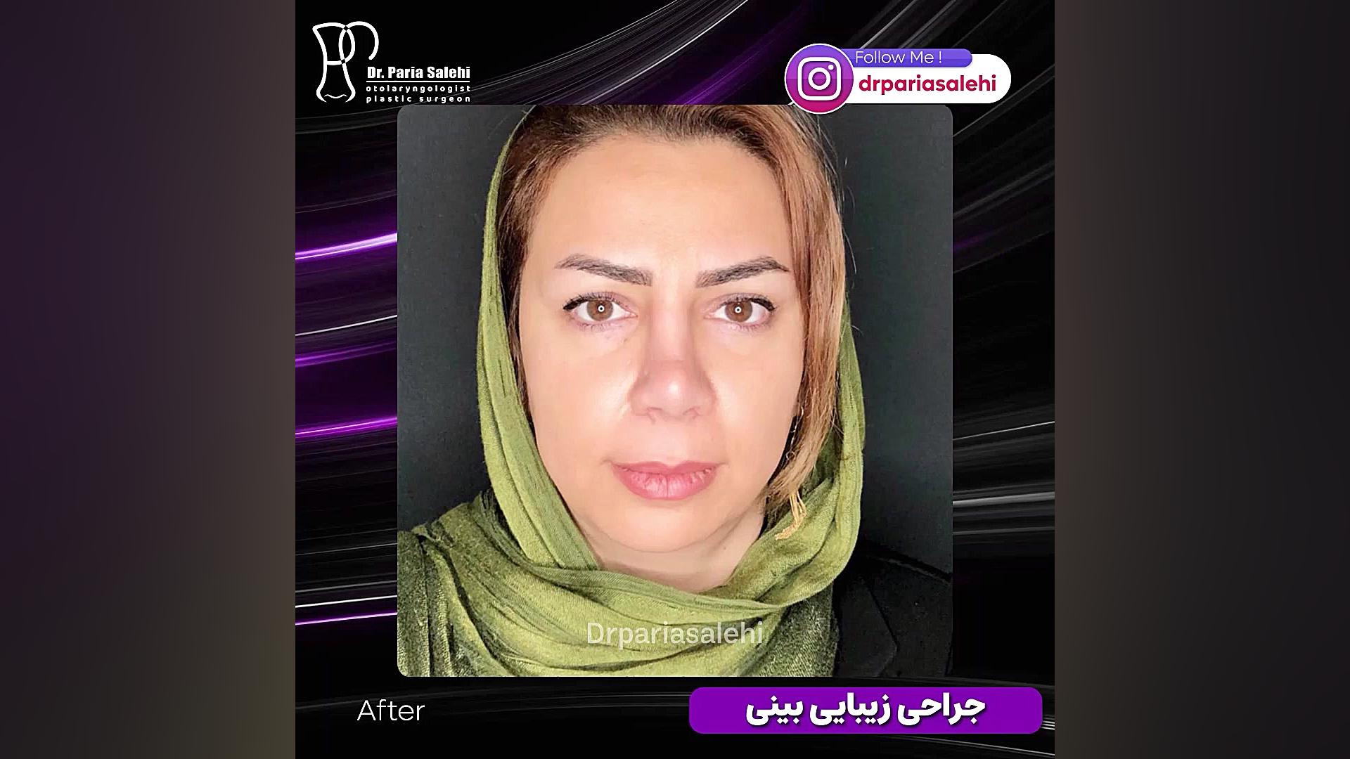 جراحی زیبایی بینی گوشتی دکتر پریا صالحی ✔ بهترین جراح بینی تهران