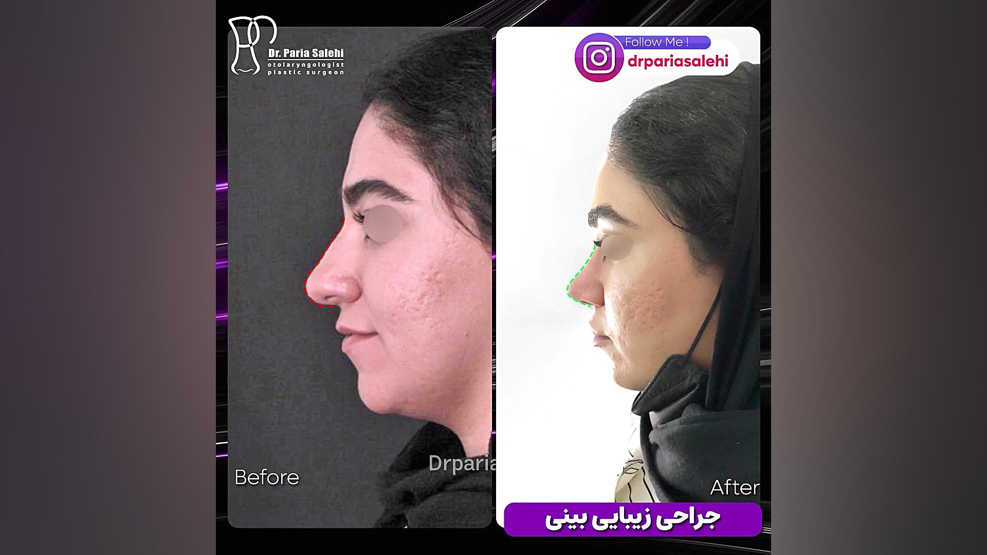 جراحی زیبایی بینی توسط بهترین جراح بینی تهران دکتر پریا صالحی ✔ بهترین جراح بینی تهران