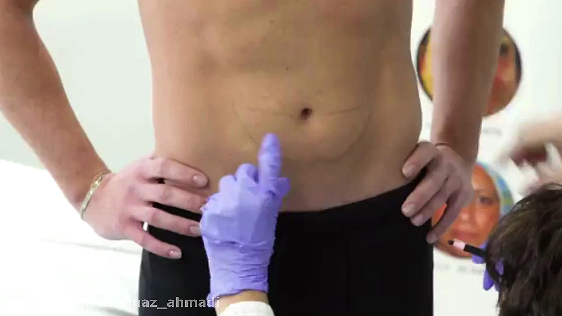 مزوتراپی شکم جراحی پف زیر چشم