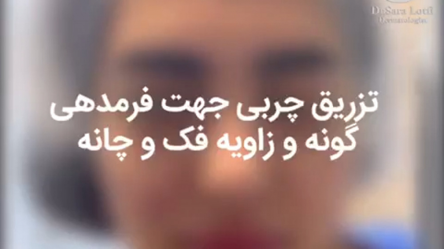 فیلم تزریق چربی برای فرم دهی فک و صورت دکتر سار ا لطفی