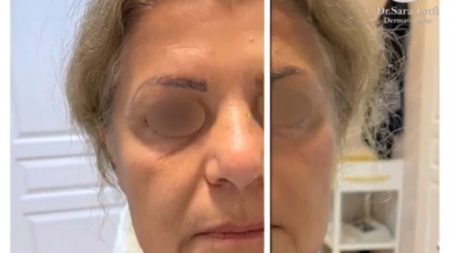 فیلم واقعی تزریق فیلر به زیر چشم دکتر سار ا لطفی