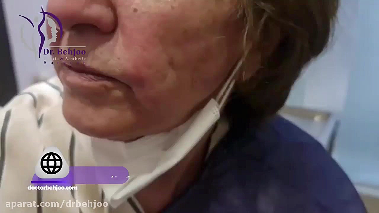 تخلیه ژل پاژ بعد از ۲۰ سال دکتر شاهین بهجو - فوق تخصص جراحی پلاستیک