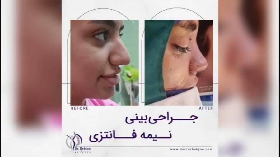جراحی بینی نیمه فانتزی دکتر شاهین بهجو - فوق تخصص جراحی پلاستیک