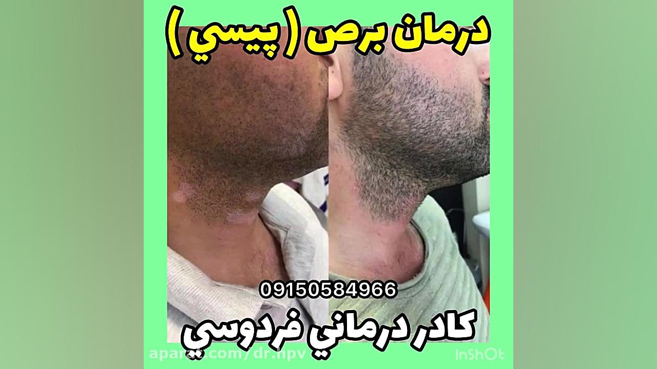 درمان پیسی ویتیلیگو کشف شد! داریوش