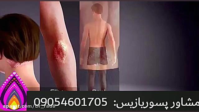 پسوریازیس با دکتر خیراندیش درمان شد حمید هیراد