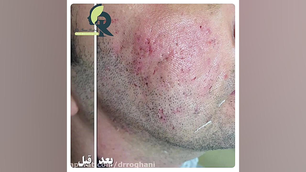 تزریق فیلر برای اسکار اکنه دکتر ایمان روغنی جراح و متخصص پوست و مو