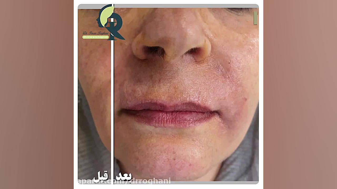 تزریق فیلر برای بهبودی خطوط دور دهان چین خنده و خط غم و خطوط ریز بالای لب دکتر ایمان روغنی جراح و متخصص پوست و مو