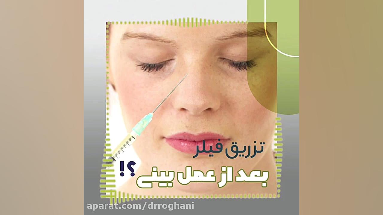 بعداز جراحی بینی فیلر بزنم ؟ دکتر ایمان روغنی جراح و متخصص پوست و مو
