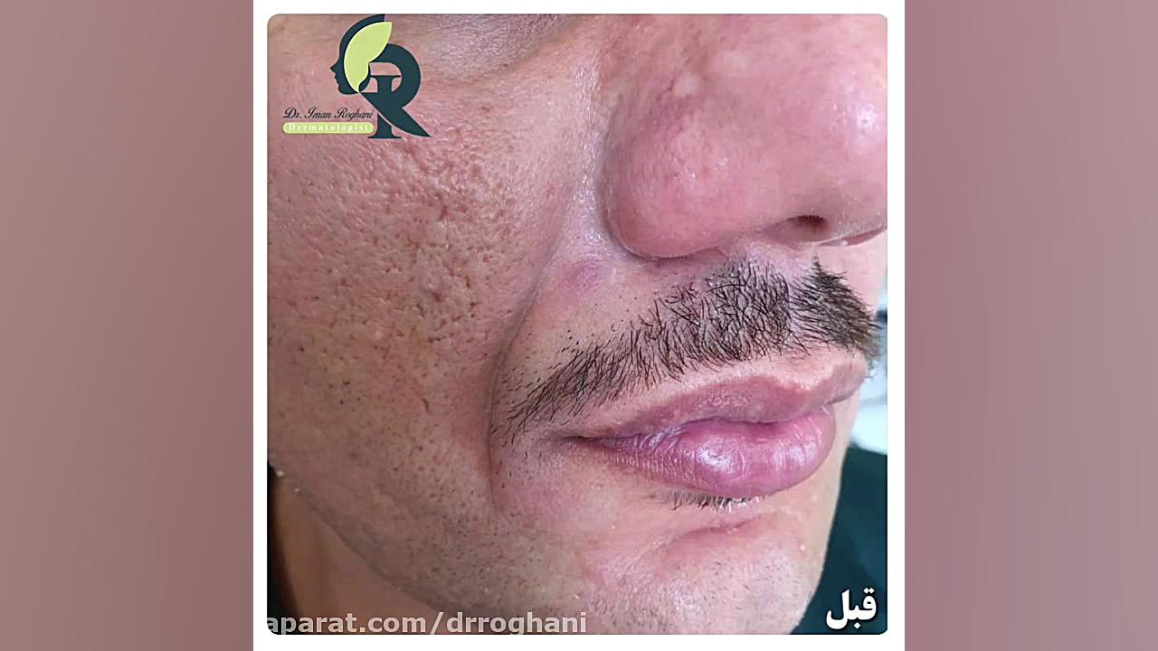 تزریق فیلر خنده برای آقایان دکتر ایمان روغنی جراح و متخصص پوست و مو
