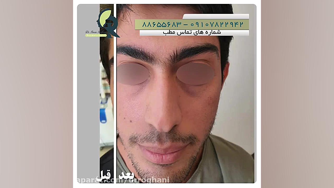 درمانهای ترکیبی برای از بین بردن جای جوش دکتر ایمان روغنی جراح و متخصص پوست و مو