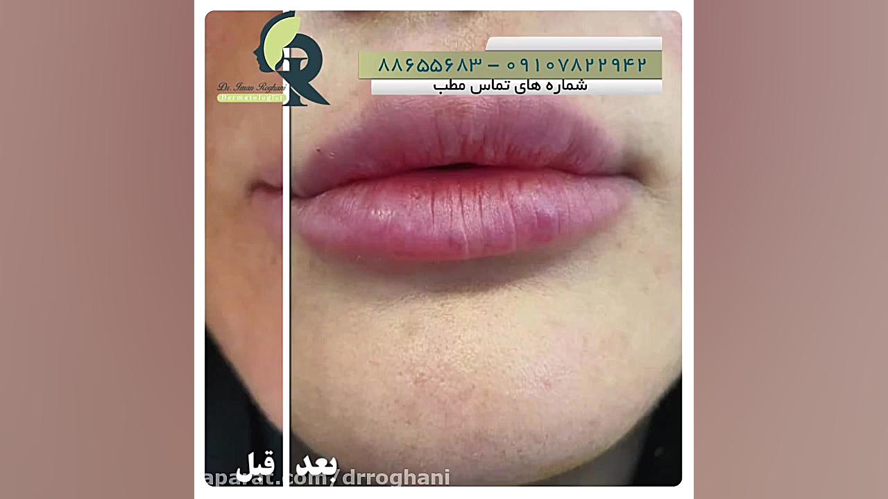 تزریق فیلر لب دکتر ایمان روغنی جراح و متخصص پوست و مو