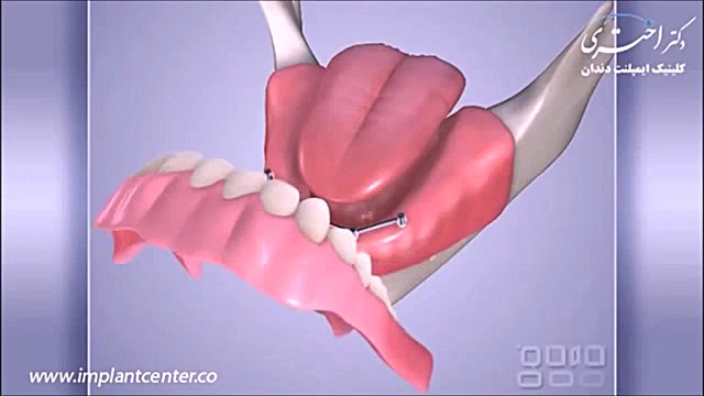 فیکس کردن دست دندان مصنوعی بررسی اروماتاز
