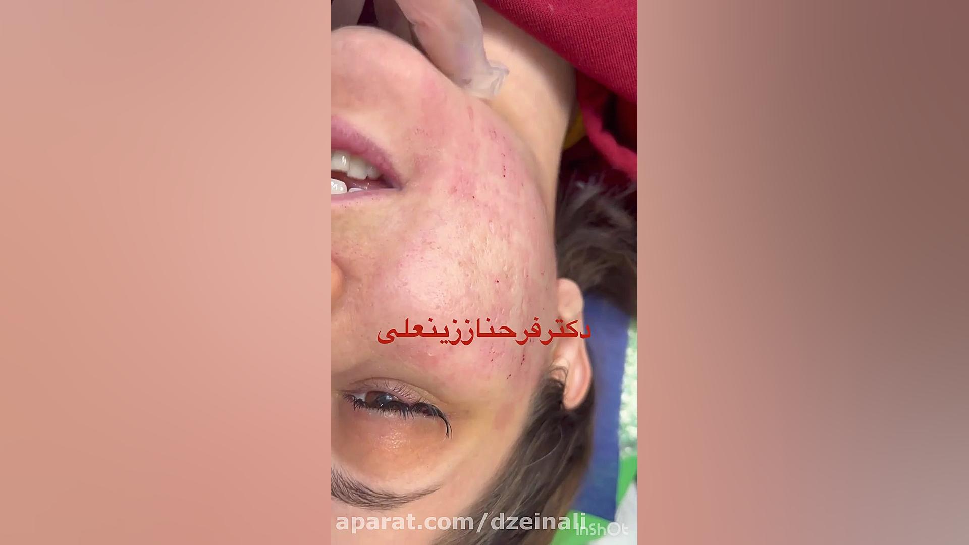 بهبود عالی اسکارهای فرورفته مدل آیس پیک که دراثر جوشها و آکنه های صورت ایجاد شده دکتر فرحناز زینعلی - متخصص پوست، مو، زیبایی زنجان