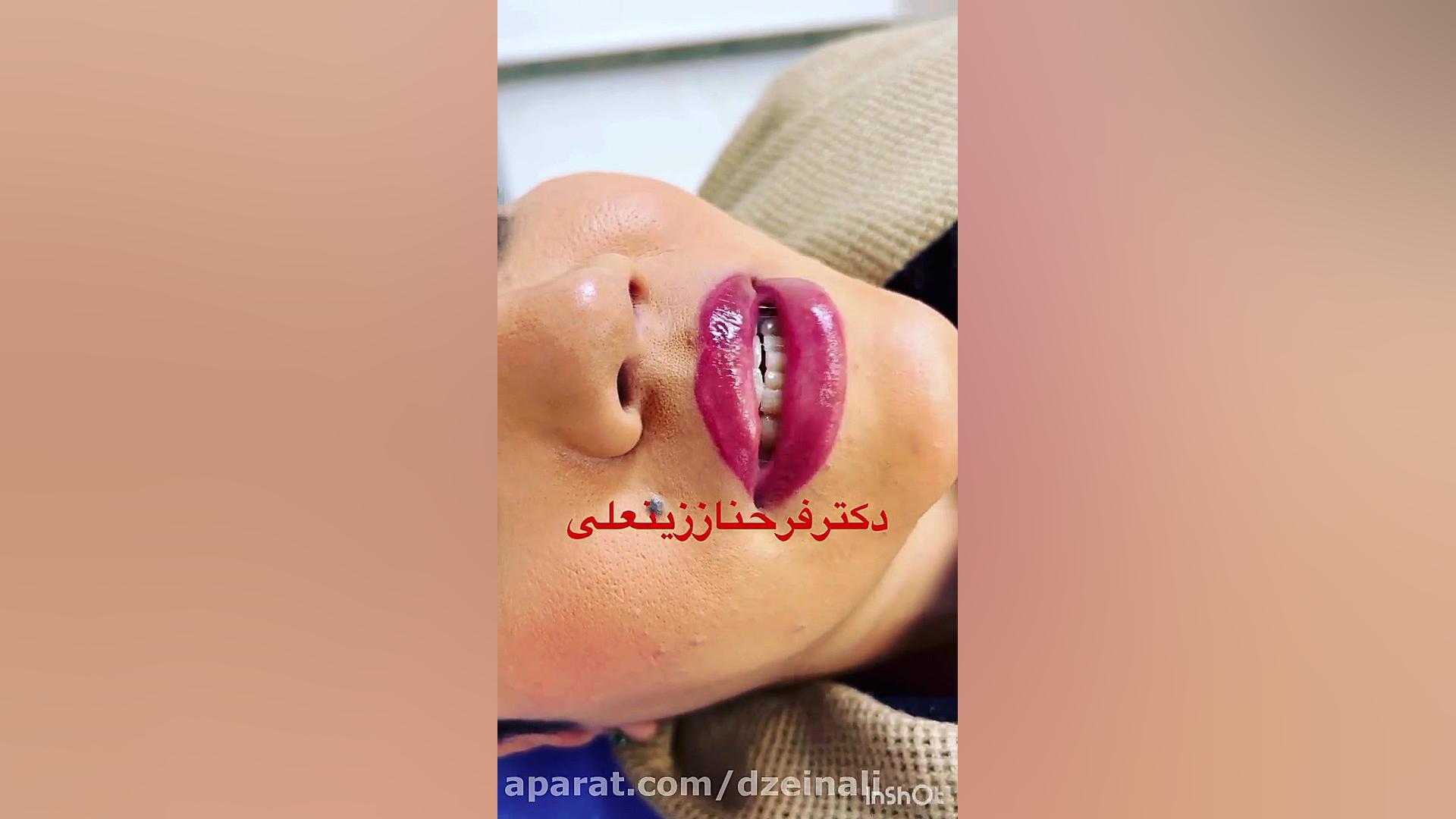 تزریق یک سی سی فیلر ژل لب به متد روسی دکتر فرحناز زینعلی - متخصص پوست، مو، زیبایی زنجان