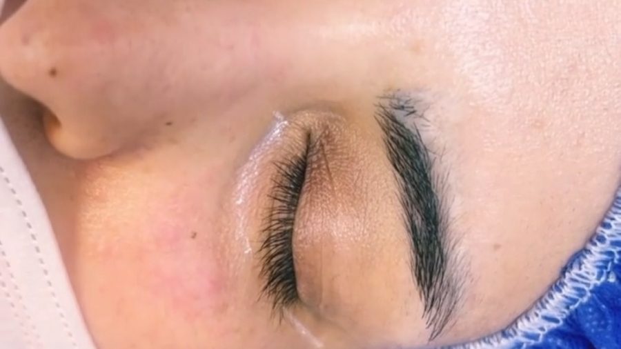 تزریق فیلر ژل زیرچشم برای رفع گودی و تیرگی زیر چشمها دکتر فرحناز زینعلی - متخصص پوست، مو، زیبایی زنجان