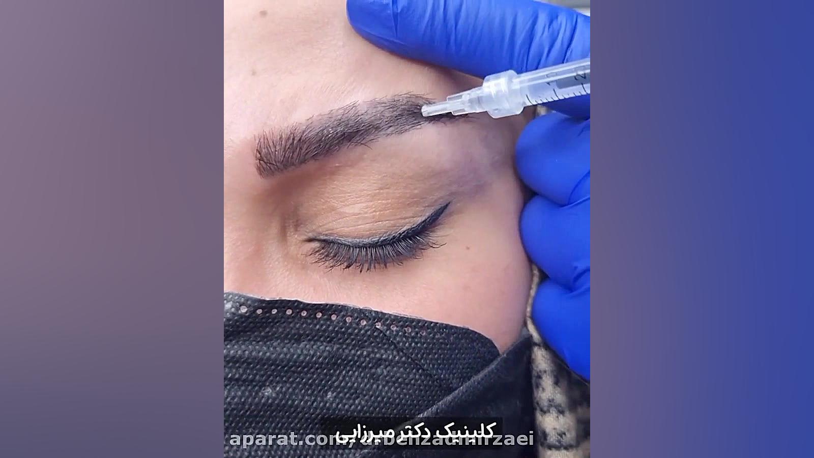 مزوتراپی ابرو اریتروبلاستوز جنینی