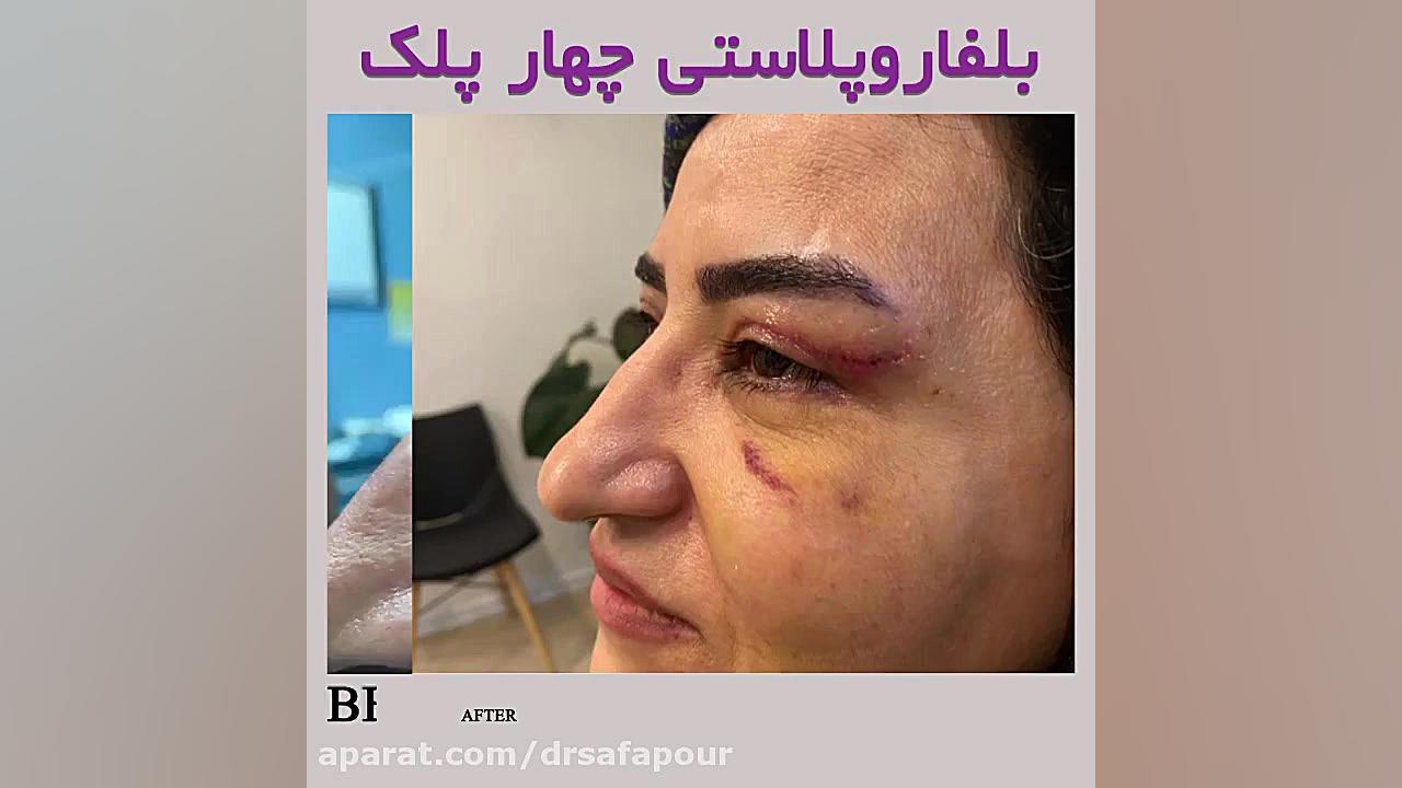 عمل جراحی چهار پلک دکتر شراره صفاپور