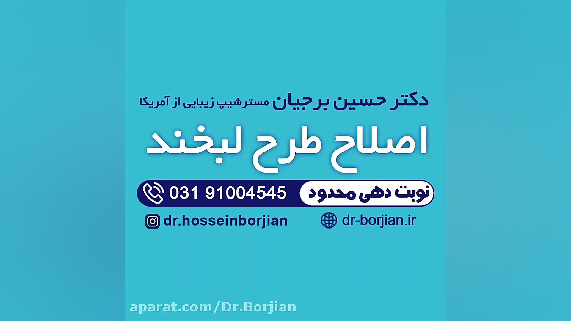 اصلاح طرح لبخند توسط بهترین دندانپزشک زیبایی اصفهان TAVI