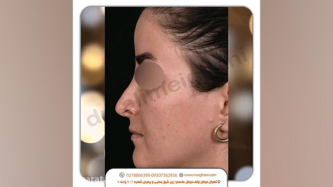 تیپ پلاستی ترمیمی بدون نیاز به بیهوشی لیفت پیشانی