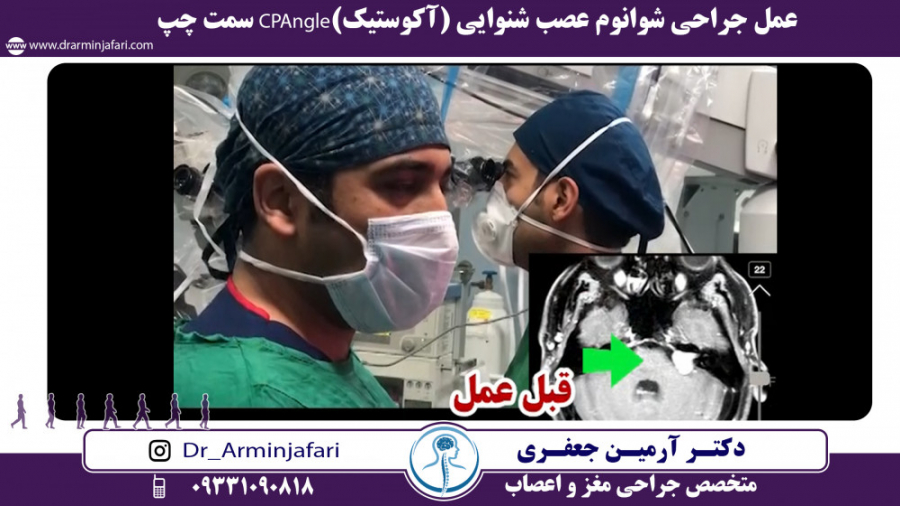 عمل جراحی شوانوم عصب شنوایی (آکوستیک)CPAngle سمت چپ اصلاح طرح لبخند
