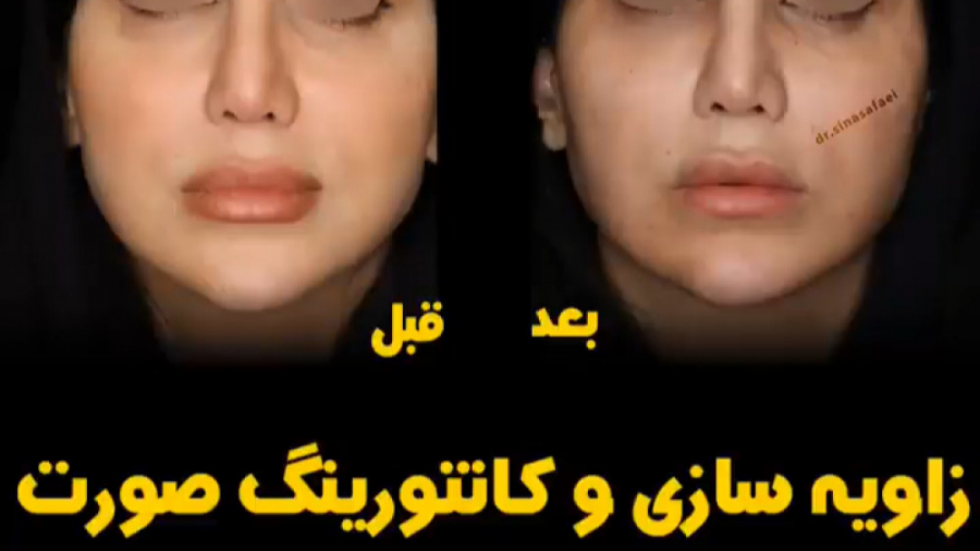 زاویه سازی و کانتورینگ صورت دکتر پوست