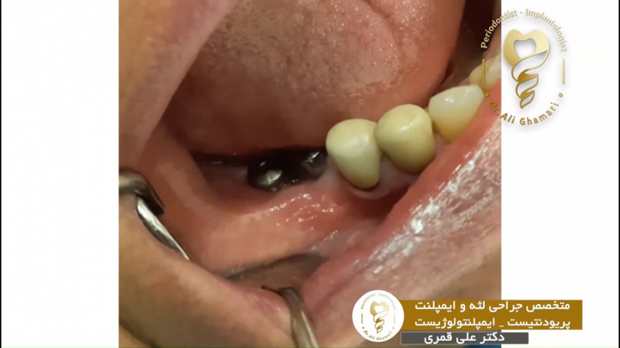 ️پیوند لثه دو ایمپلنت ️ دکتر علی قمری - متخصص جراحی لثه و ایمپلنت
