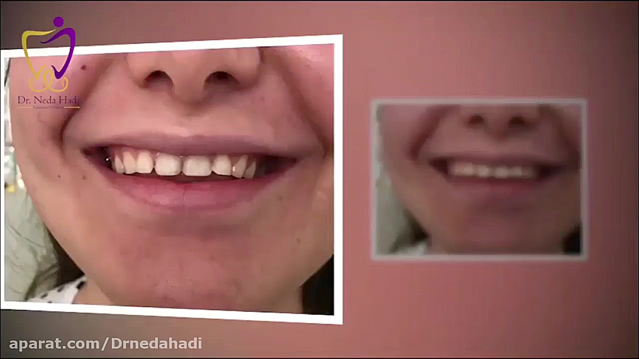 فیلم واقعی کامپوزیت دندان دکتر ندا هادی-دندانپزشک زیبایی
