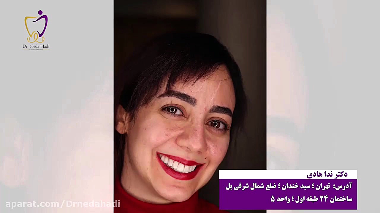 فیلم واقعی کامپوزیت دندان دکتر ندا هادی-دندانپزشک زیبایی