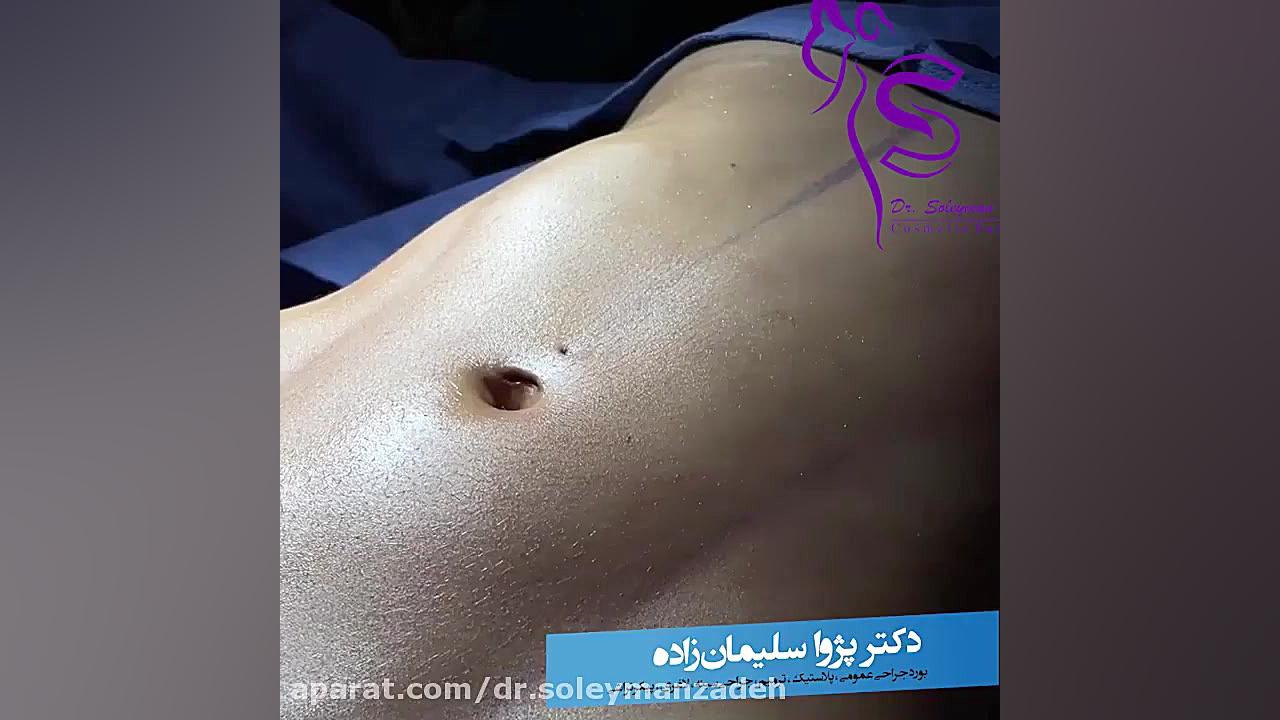 لیپوماتیک ناحیه کوچکی از شکم بدون هیچ گونه اثر و ردی از جراحی لیزر کوانتومی جراحی چشم