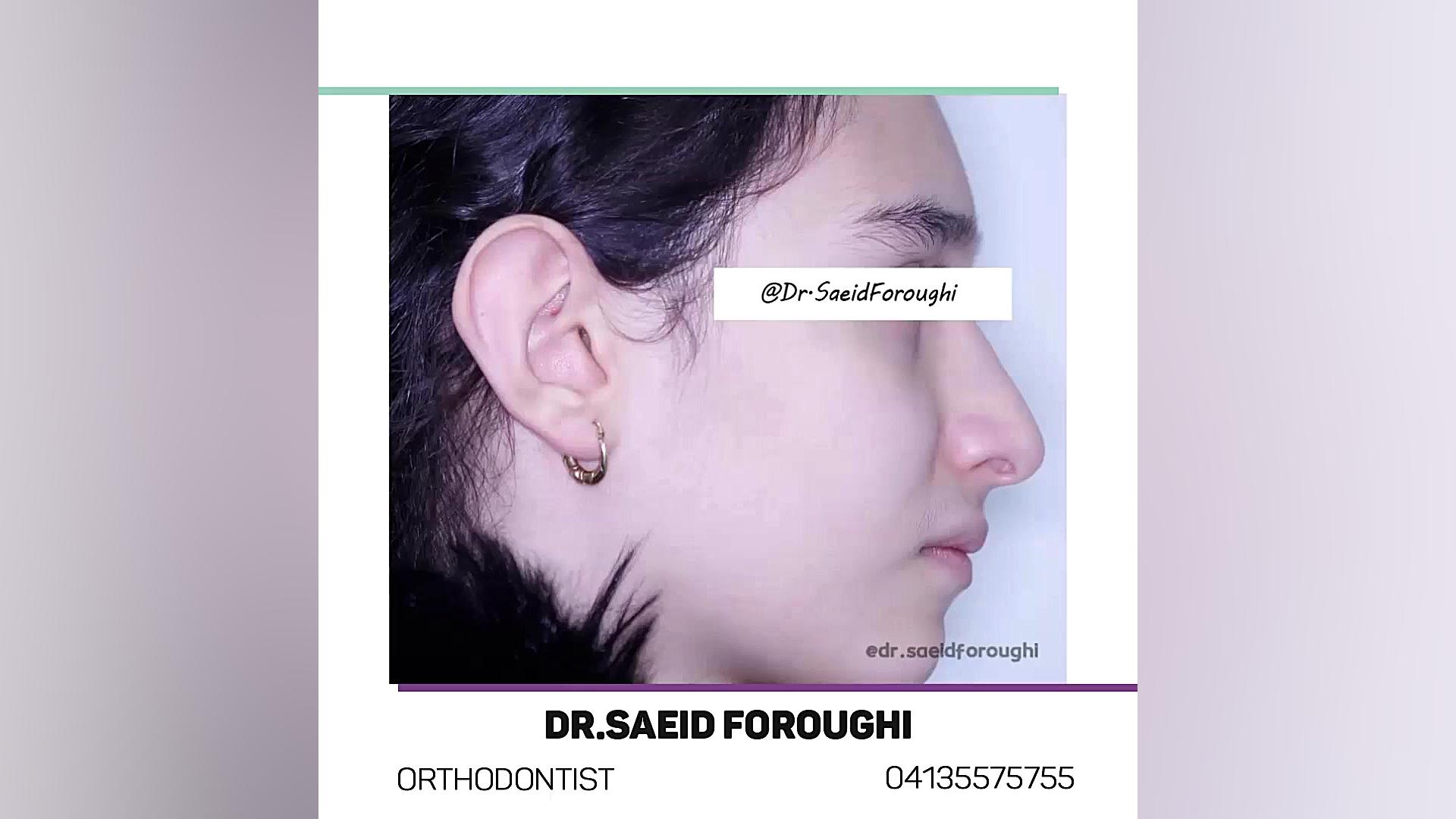 نمونه عالی از یک درمان با همکاری متخصصین در چند حوزه مختلف دکتر سعید فروغی متخصص ارتودنسی
