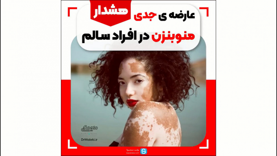 عارضه ی جدی منوبنزن در افراد سالم دکتر مریم ملکی - کلینیک پوست و مو و زیبایی هور