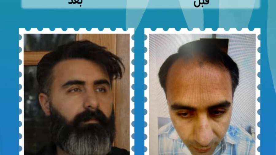 کاشت مو طبیعی در کلینیک میشا کلینیک میشا (دکتر سید حسن حسینی)