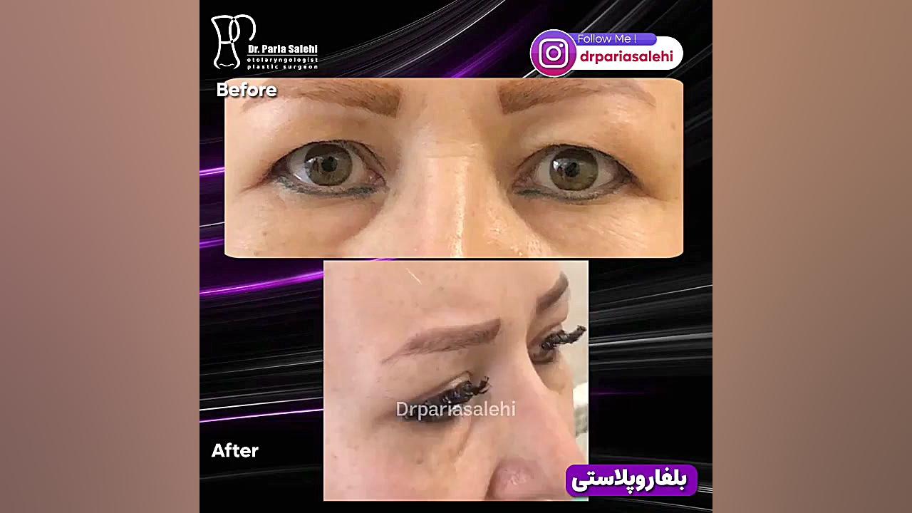 بلفاروپلاستی دکتر پریا صالحی ✔ بهترین جراح بینی تهران