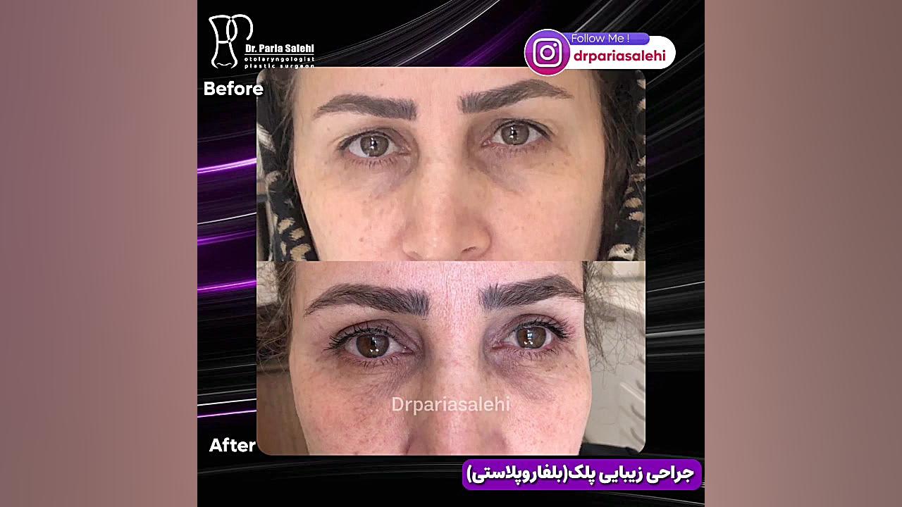 جراحی زیبایی پلک دکتر پریا صالحی ✔ بهترین جراح بینی تهران