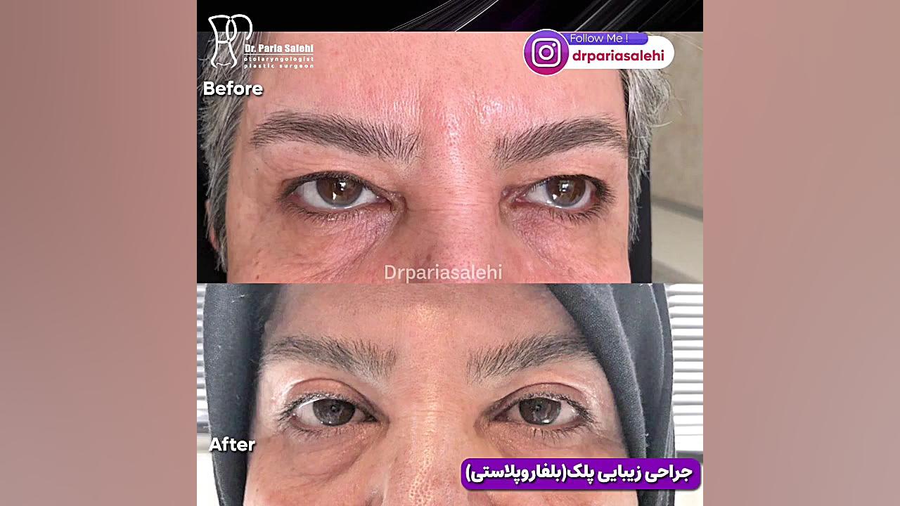 سنگینی پلک ها و جراحی پلک دکتر پریا صالحی ✔ بهترین جراح بینی تهران