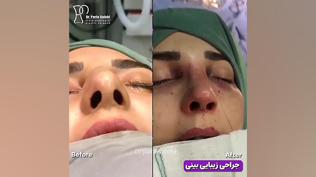 جراحی زیبایی بینی به فرم طبیعی دکتر پریا صالحی ✔ بهترین جراح بینی تهران