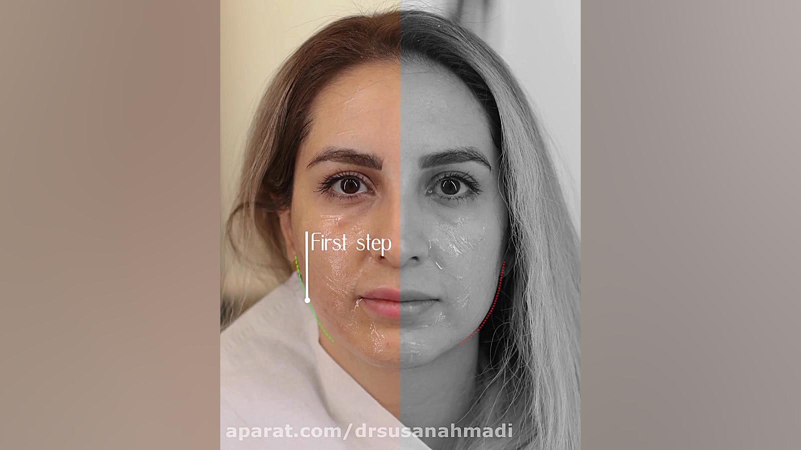 فیلم لیفت صورت دکتر سوسن احمدی پیر شهید