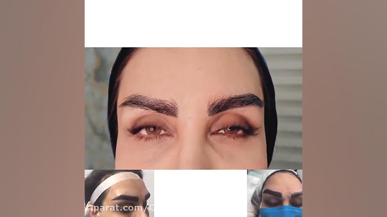 کاشت ابرو کلینیک پوست و مو اورانوس سندرم تریشن-کولینز نادر