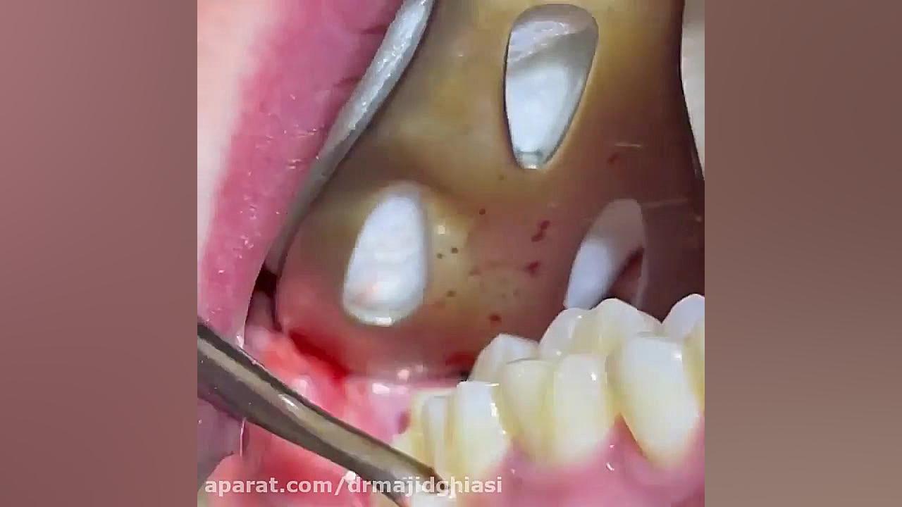 جراحی دندان عقل در 5 دقیقه دکترمجیدقیاسی