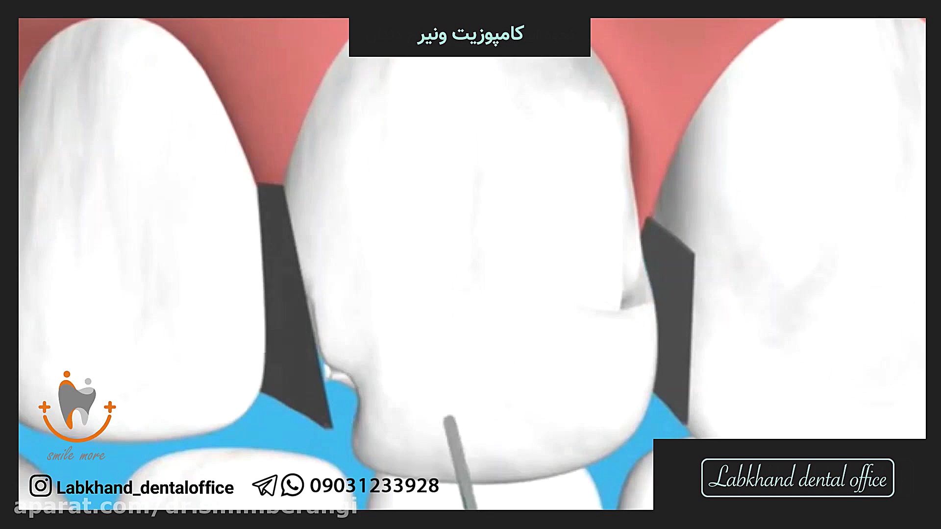 لمینیت سرامیکی دکتر سیمین برنگی | Dr Simin Berangi