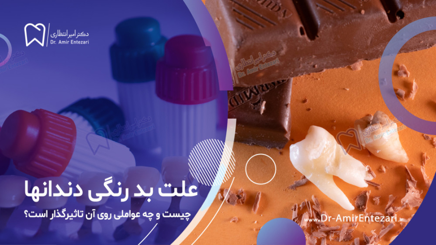 بد رنگی دندان دکتر امیر انتظاری
