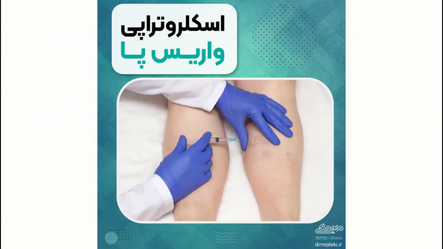 اسکلروتراپی واریس پا(طی ۱ تا ۲جلسه) دکتر مریم ملکی - کلینیک پوست و مو و زیبایی هور