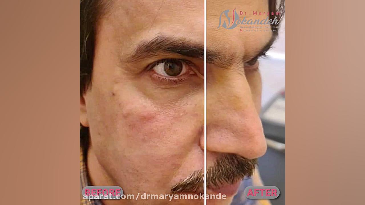 فیلم واقعی تزریق فیلر زیر چشم دکتر مریم نوکنده