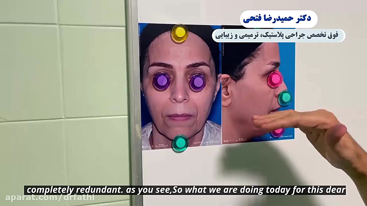 فیلم لیفت آندوسکوپی صورت دکتر حمید رضا فتحی فوق تخصص جراحی پلاستیک