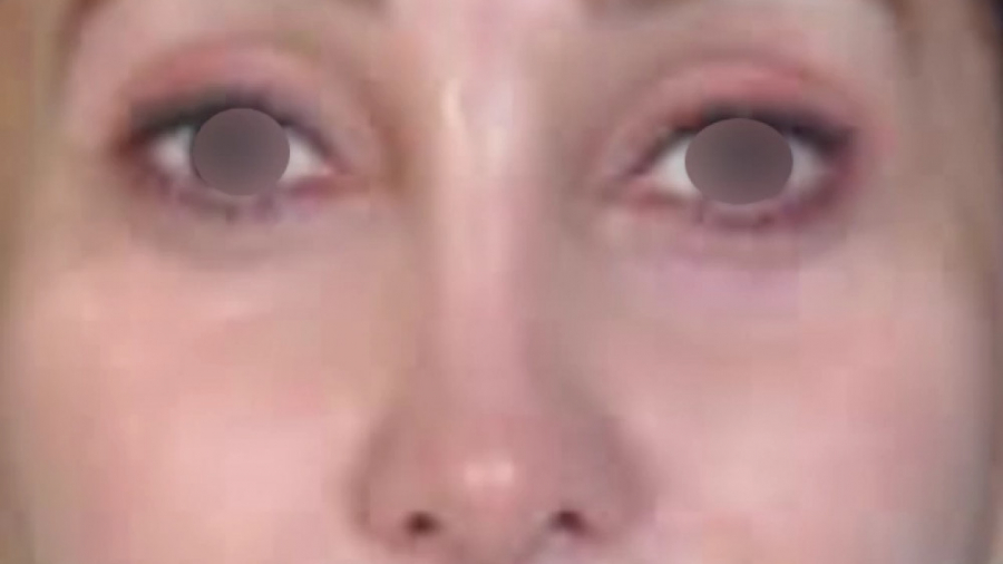 عمل بلفاروپلاستی به همراه عمل ترمیمی بینی دکتر حمید رضا فتحی فوق تخصص جراحی پلاستیک