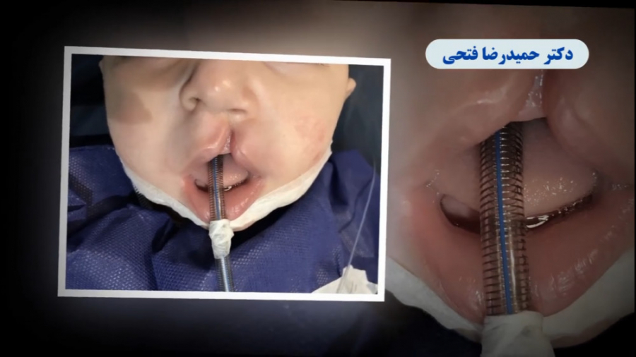 فیلم جراحی شکاف لب دکتر حمید رضا فتحی فوق تخصص جراحی پلاستیک