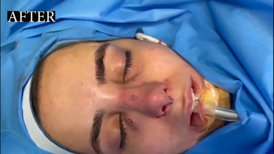 فیلم جراحی بینی از نمای نزدیک در اتاق عمل پر کردن دندان