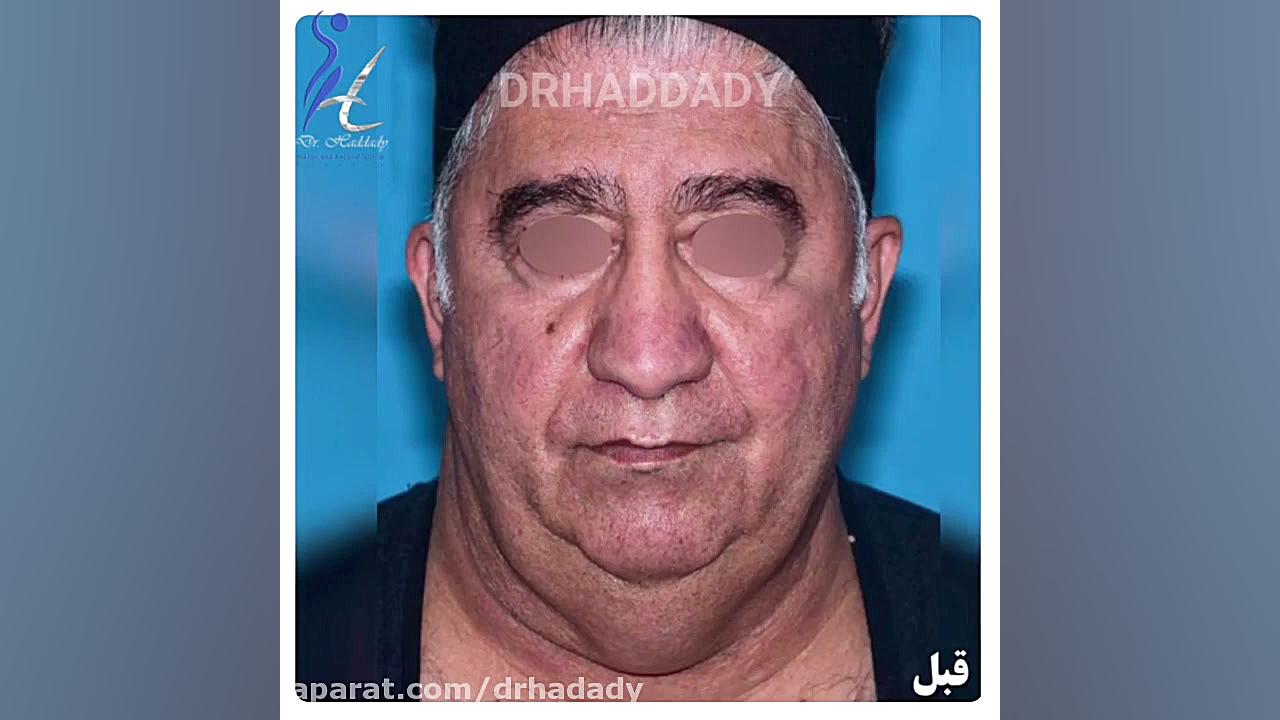 جراحی لیفت صورت و گردن کاشت مو